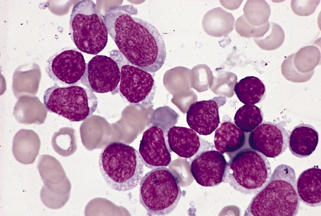 Leucemia linfoide canina. Leucemia linfoblástica aguda y leucemia linfocítica crónica.